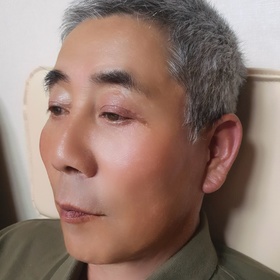 안면거상